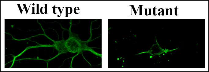 These images depict two nerve cells. The image on the left shows the action of healthy SLC30A10 at full function, including acting as gate keeper to aid in removing excessive levels of manganese from the cell. The image on the right shows the disease-causing mutation of the same gene as it is shriveled and dying.