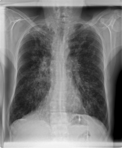 Xray of person with cystic fibrosis