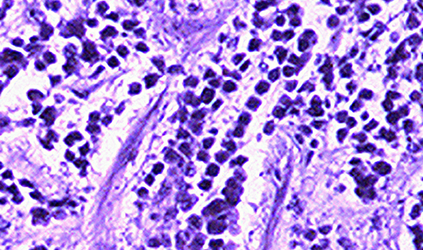 Breast cancer cells