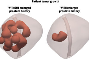Computer rendering of prostate tumors.