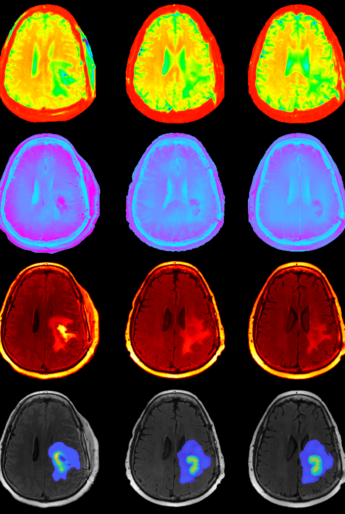 MDACChigradeglioma6521 copy