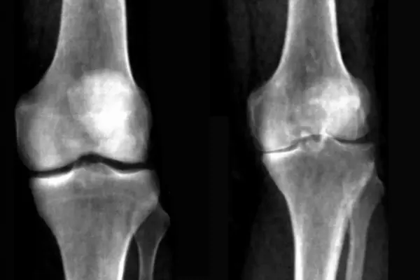xray of knee bone