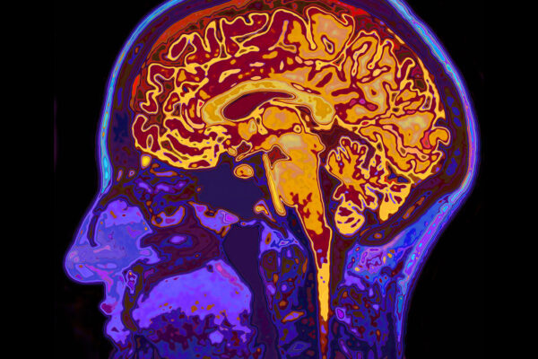 purple and orange scan of brain from the profile angle