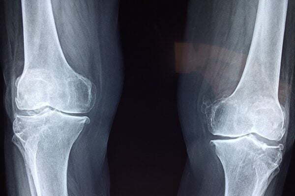 Knee X-ray