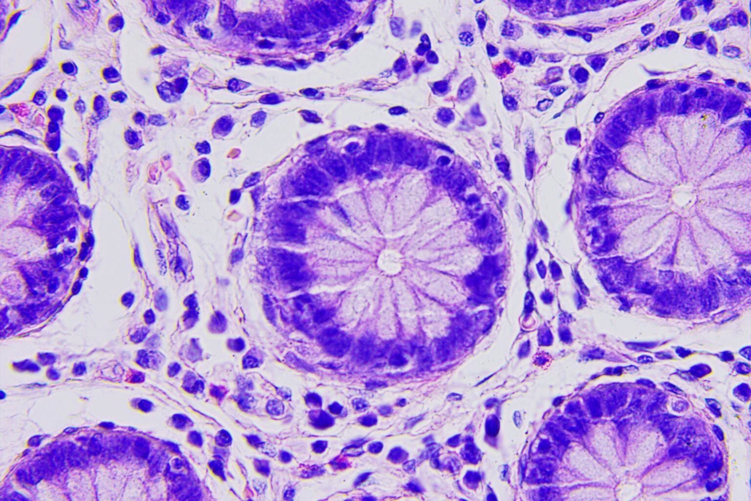 Microscope image of colon cancer cells.