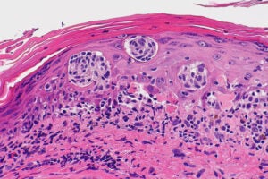 image of melanoma