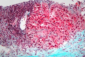 Microscope image of cancer cell.