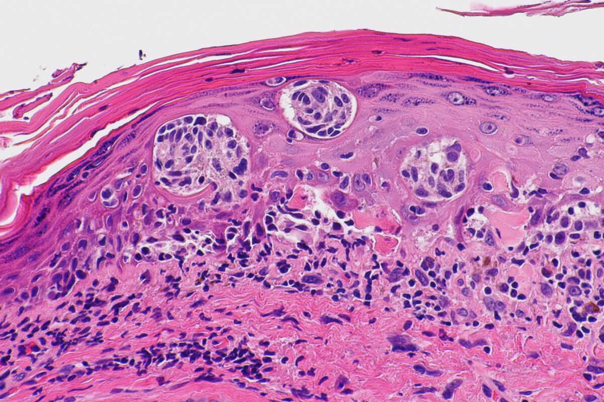 An image of melanoma.